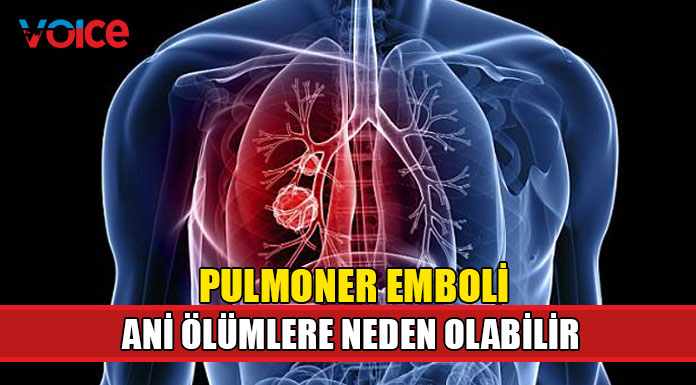 Akciğer damarlarına pıhtı atması olarak bilinen pulmoner embolinin belirtileri nelerdir?