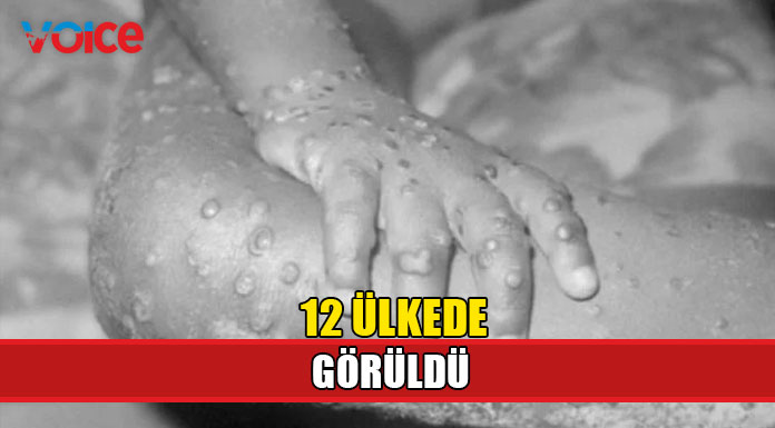 Maymun çiçeği virüsü yayılıyor
