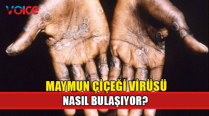 Maymun çiçeği virüsü küresel paniğe yol açtı