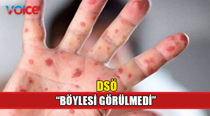 Maymun çiçeği vakaları birkaç günde iki katına çıktı