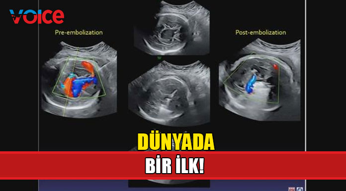 ABD'de anne karnındaki bebeğe beyin ameliyatı yapıldı