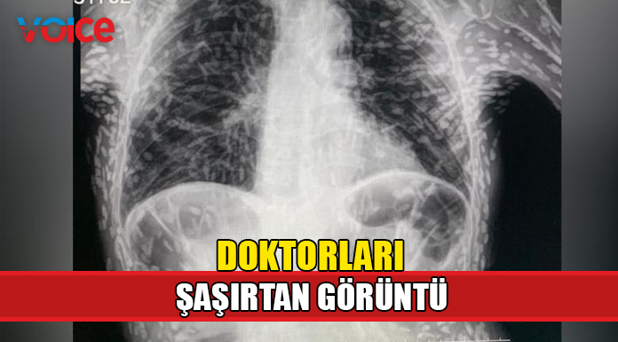 Öksürük şikayetiyle hastaneye gitti, midesinden onlarca tenya çıktı